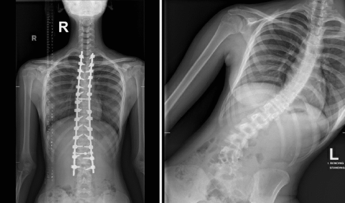 Sheikh Shakhbout Medical City completes first complex scoliosis surgery
